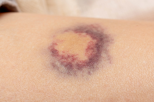 hematoma-woman-s-body-as-result-violence.jpg
